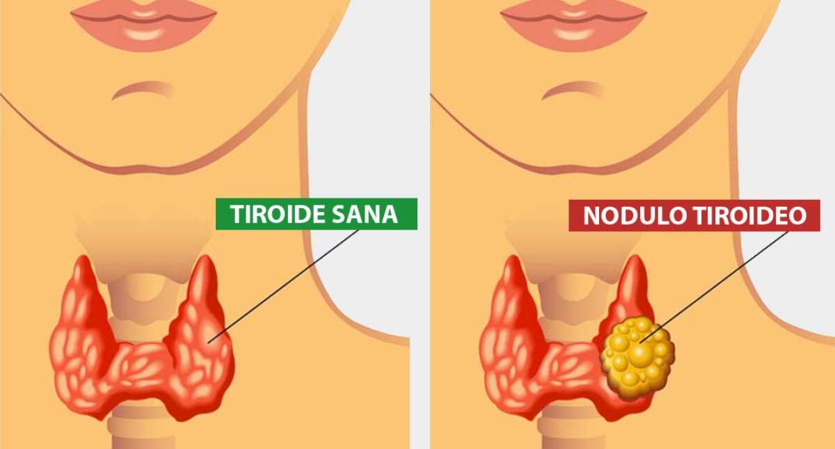 Settimana mondiale della tiroide: Lilt promuove la prevenzione - 