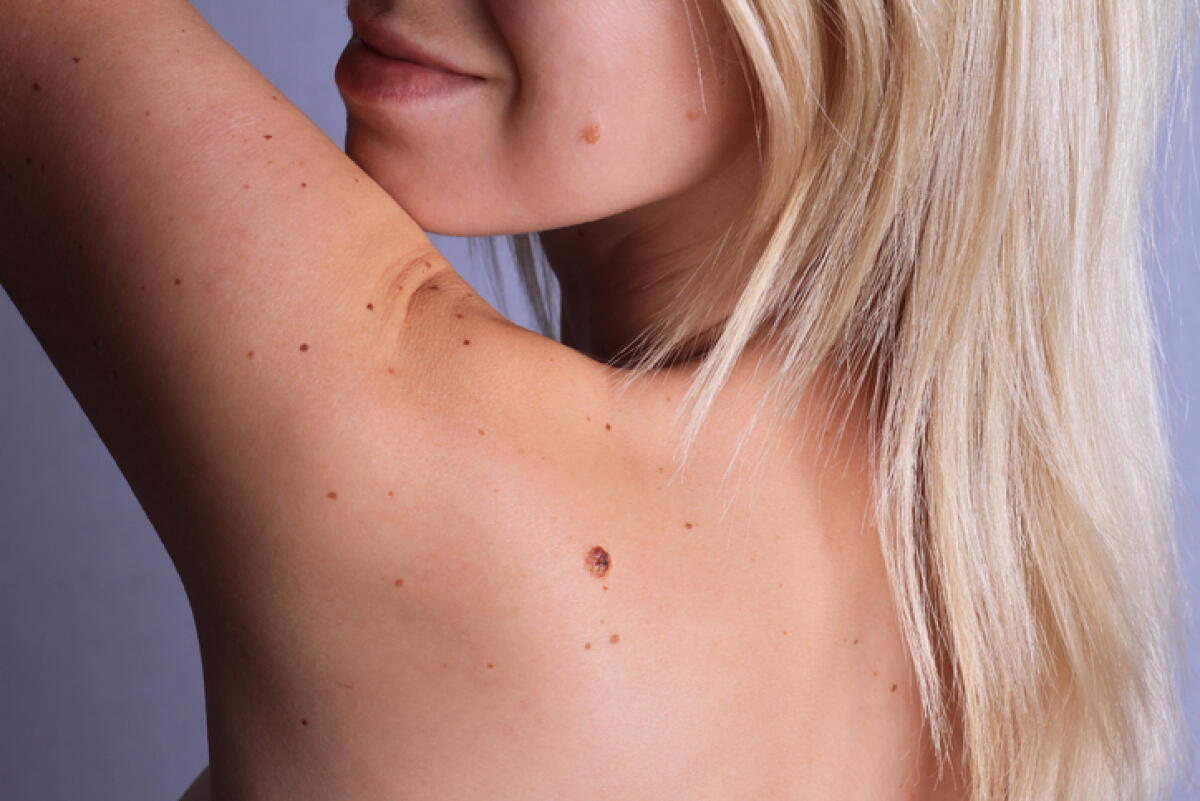 “Arriva l’estate… Uniti per la pelle”: campagna di prevenzione dei tumori cutanei - Checking benign moles : Woman with birthmarks on her back and face