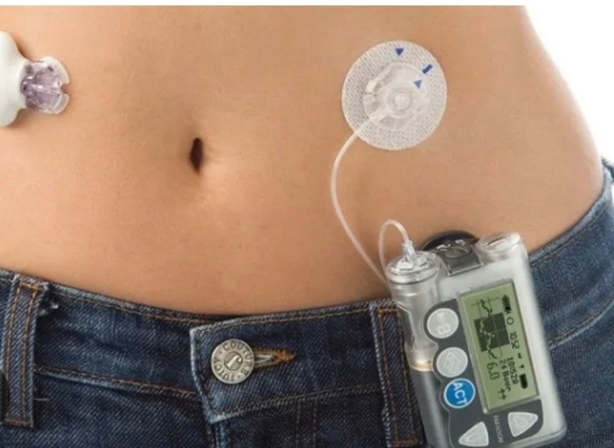 Le esigenze di  bambini e giovani con  Diabete 1 - 