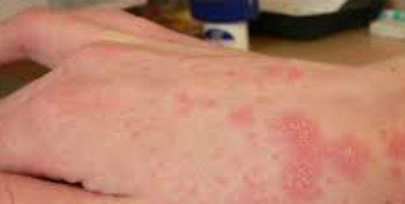 Caso di scabbia norvegese in un minore  - 